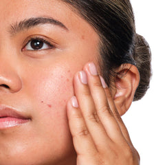 Salicylic Acid 2% Solution